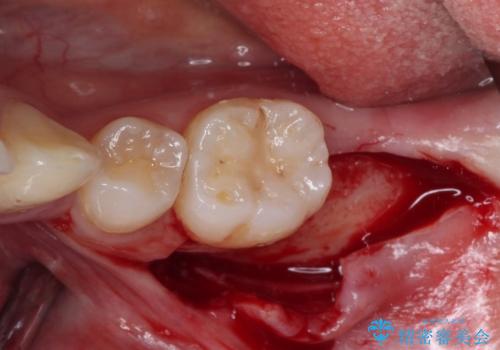 部分矯正を併用した奥歯のインプラント治療の治療前