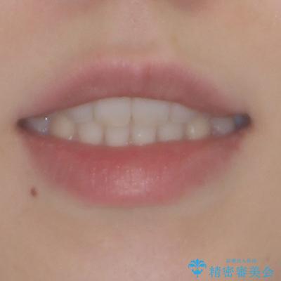 すきっ歯とオープンバイト　インビザライン・ライトで改善の治療後（顔貌）