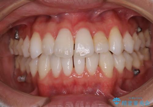 【非抜歯】八重歯を治す マウスピース矯正の治療中