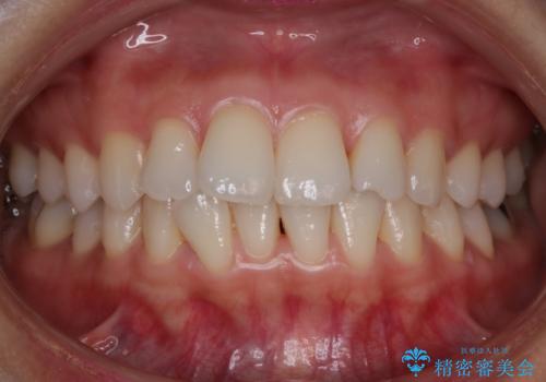 【非抜歯】前歯のガタつき マウスピースの部分矯正の治療前