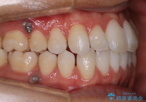 【非抜歯】八重歯を治す　マウスピース矯正の治療中