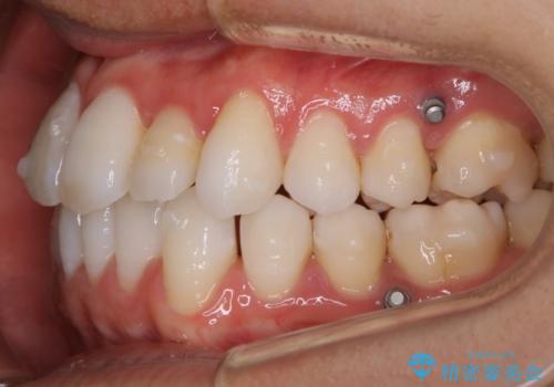 【非抜歯】八重歯を治す マウスピース矯正の治療中