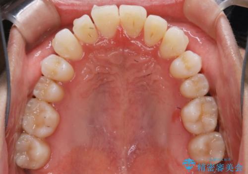 【非抜歯】八重歯を治す マウスピース矯正の治療中