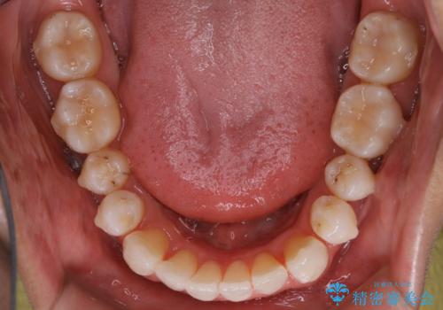 【非抜歯】八重歯を治す　マウスピース矯正の治療中
