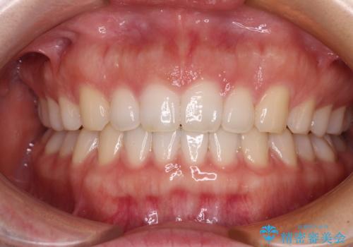 すきっ歯とオープンバイト　インビザライン・ライトで改善の症例 治療後