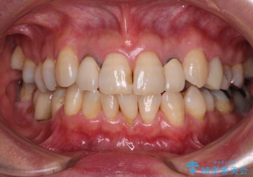 歯根が見えてしみる　歯肉移植による歯肉退縮の改善の症例 治療前