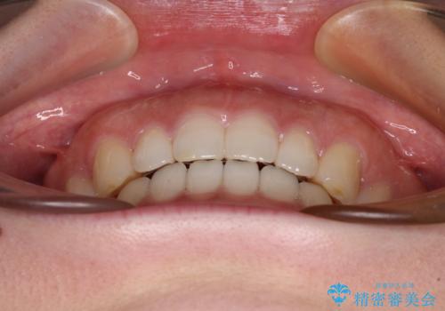 すきっ歯とオープンバイト　インビザライン・ライトで改善の治療後