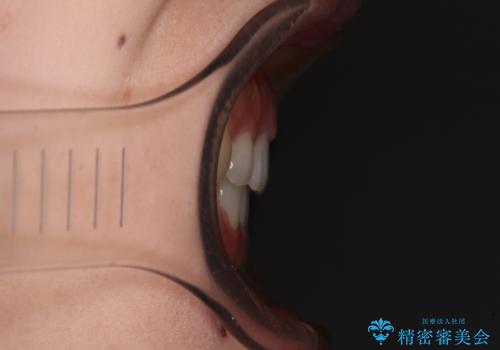 すきっ歯とオープンバイト インビザライン・ライトで改善の治療後