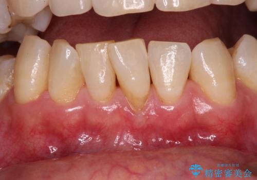 歯根が見えてしみる　歯肉移植による歯肉退縮の改善
