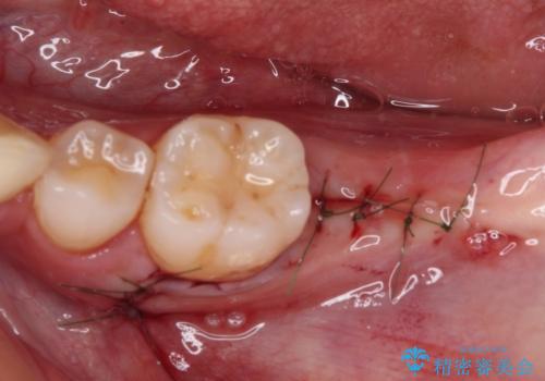 部分矯正を併用した奥歯のインプラント治療の治療後