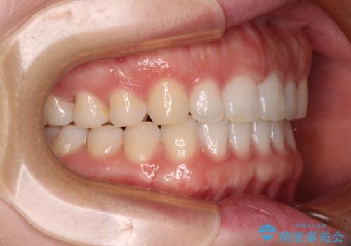 すきっ歯とオープンバイト インビザライン・ライトで改善の治療後