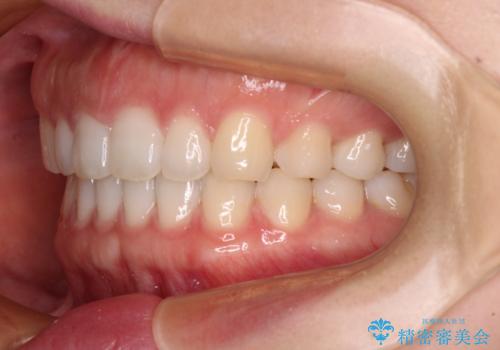 すきっ歯とオープンバイト インビザライン・ライトで改善の治療後