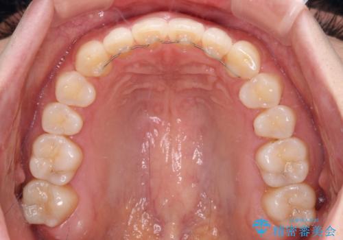 すきっ歯とオープンバイト インビザライン・ライトで改善の治療後