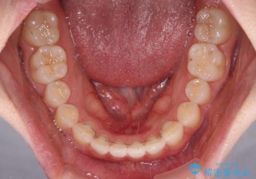 すきっ歯とオープンバイト　インビザライン・ライトで改善の治療後