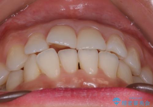 【非抜歯】前歯のガタつき　マウスピースの部分矯正の治療前