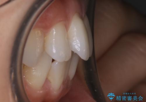 【非抜歯】前歯のガタつき マウスピースの部分矯正の治療前