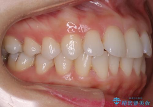 【非抜歯】前歯のガタつき　マウスピースの部分矯正の治療前