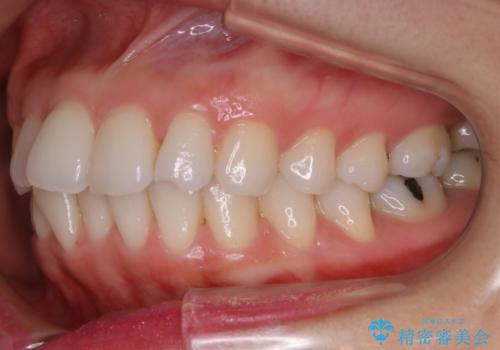 【非抜歯】前歯のガタつき マウスピースの部分矯正の治療前
