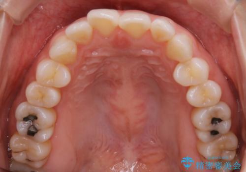 【非抜歯】前歯のガタつき マウスピースの部分矯正の治療前