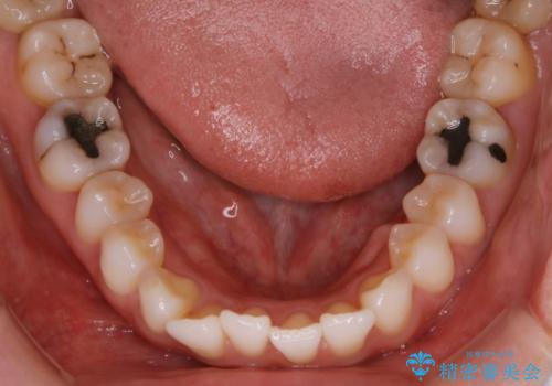 【非抜歯】前歯のガタつき マウスピースの部分矯正の治療前