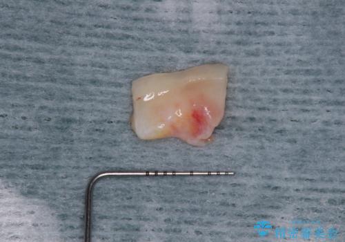 歯根が見えてしみる　歯肉移植による歯肉退縮の改善の治療前