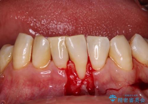 歯根が見えてしみる　歯肉移植による歯肉退縮の改善の治療前