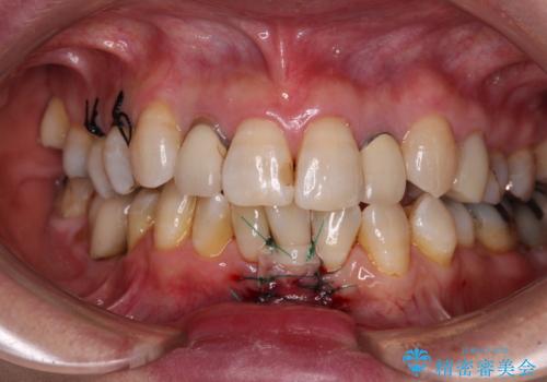 歯根が見えてしみる　歯肉移植による歯肉退縮の改善の治療中