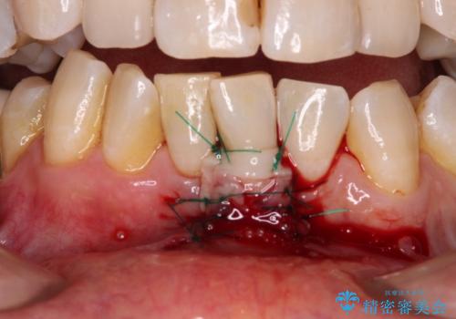 歯根が見えてしみる 歯肉移植による歯肉退縮の改善の治療中