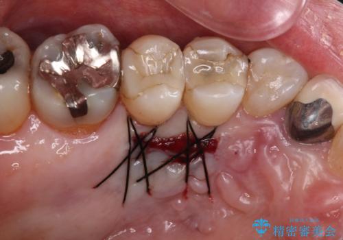 歯根が見えてしみる　歯肉移植による歯肉退縮の改善の治療中