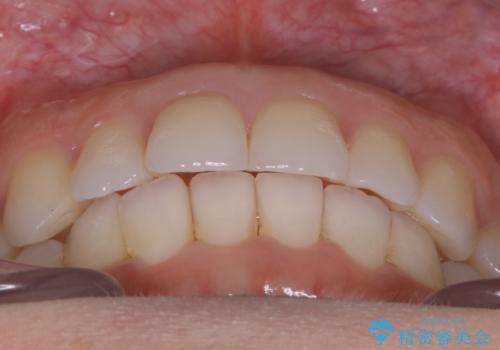 【非抜歯】前歯のガタつき マウスピースの部分矯正の治療後