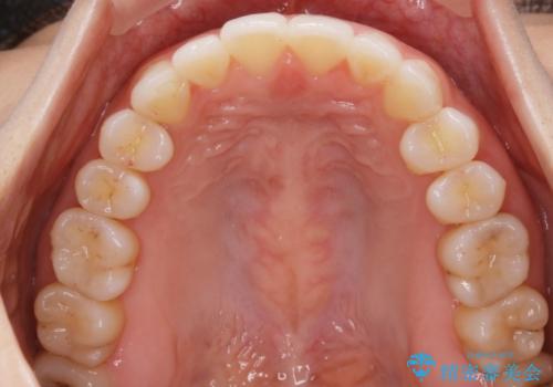 【非抜歯】前歯のガタつき マウスピースの部分矯正の治療後