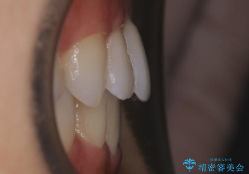 【非抜歯】前歯のガタつき　マウスピースの部分矯正の治療後