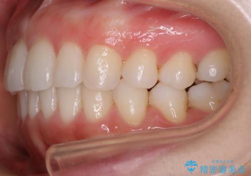 【非抜歯】前歯のガタつき　マウスピースの部分矯正の治療後