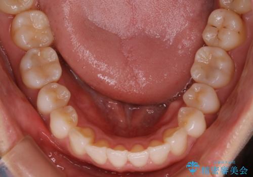 【非抜歯】前歯のガタつき マウスピースの部分矯正の治療後