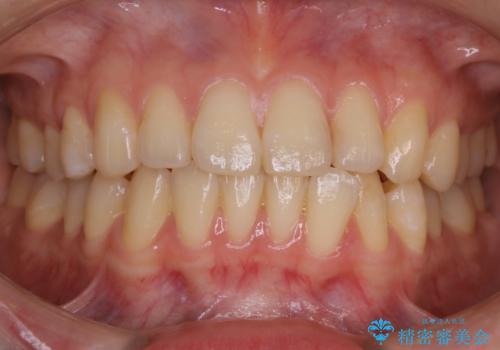 【非抜歯】部分矯正で自信の持てる歯並びへの治療前