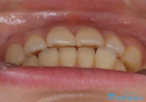 【非抜歯】部分矯正で自信の持てる歯並びへの治療前