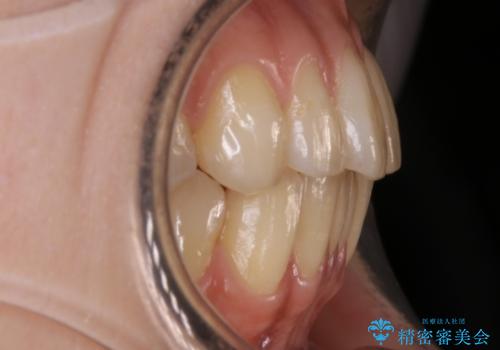 【非抜歯】部分矯正で自信の持てる歯並びへの治療前