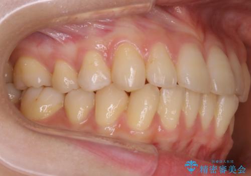 【非抜歯】部分矯正で自信の持てる歯並びへの治療前