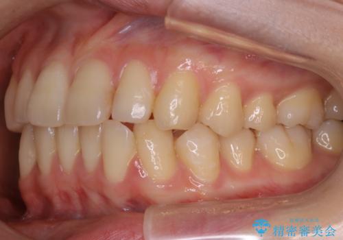 【非抜歯】部分矯正で自信の持てる歯並びへの治療前