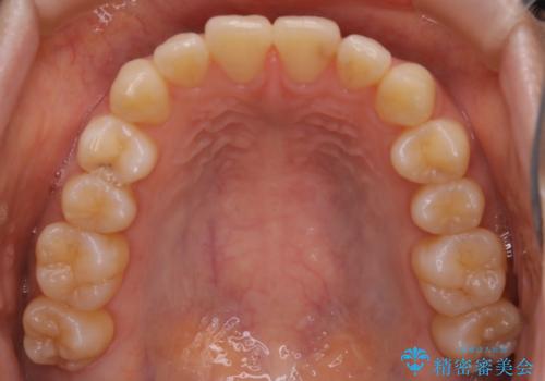 【非抜歯】部分矯正で自信の持てる歯並びへの治療前