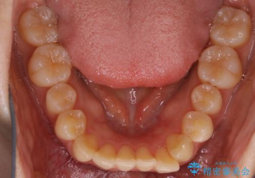 【非抜歯】部分矯正で自信の持てる歯並びへの治療前