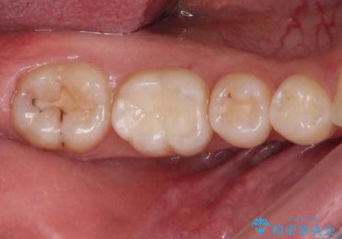 むし歯治療した歯にセラミックを入れたい セラミックインレー修復の治療後