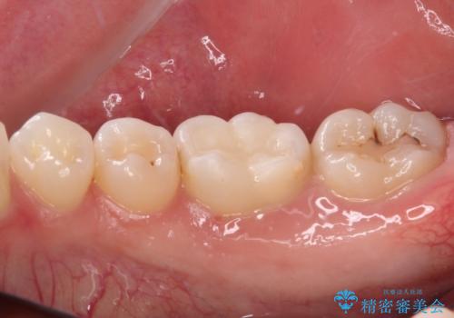 むし歯治療した歯にセラミックを入れたい セラミックインレー修復の治療後