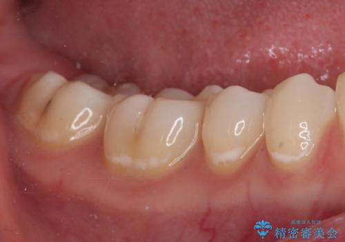 むし歯治療した歯にセラミックを入れたい セラミックインレー修復の治療後