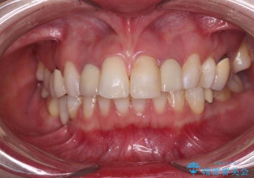 金属の見えてしまったクラウン セラミッククラウンで自然にの治療前