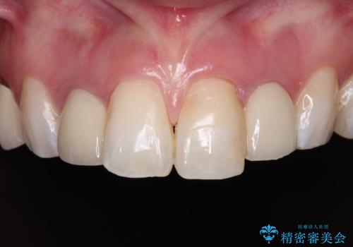 金属の見えてしまったクラウン セラミッククラウンで自然にの症例 治療前