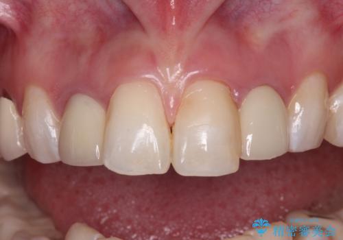 金属の見えてしまったクラウン セラミッククラウンで自然にの治療前