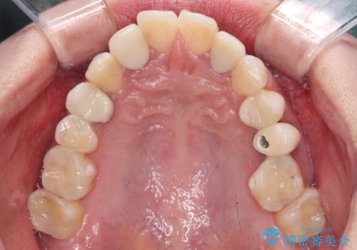 金属の見えてしまったクラウン セラミッククラウンで自然にの治療前