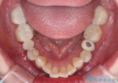 金属の見えてしまったクラウン セラミッククラウンで自然にの治療前