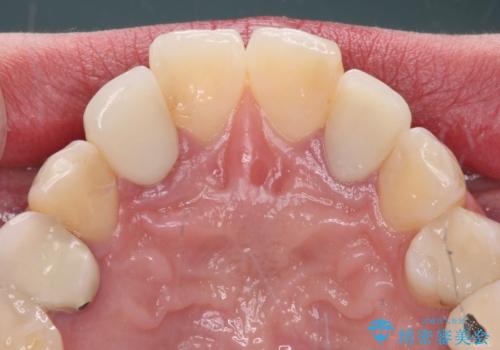 金属の見えてしまったクラウン セラミッククラウンで自然にの治療前